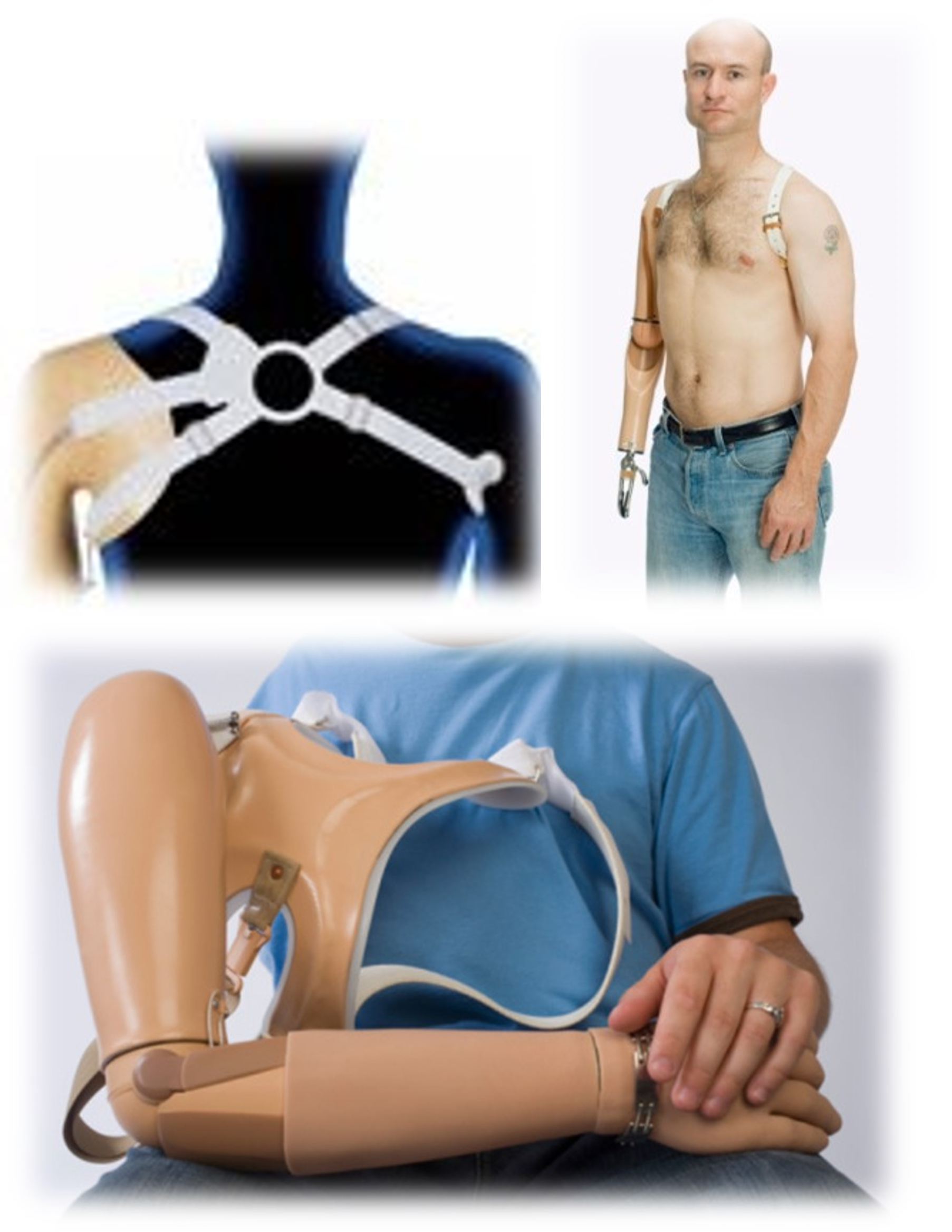 Üst Ekstremite Kol Protezleri