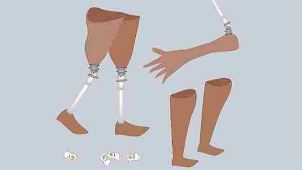 Protez Uzuv Almadan Önce Yapılması Gerekenler