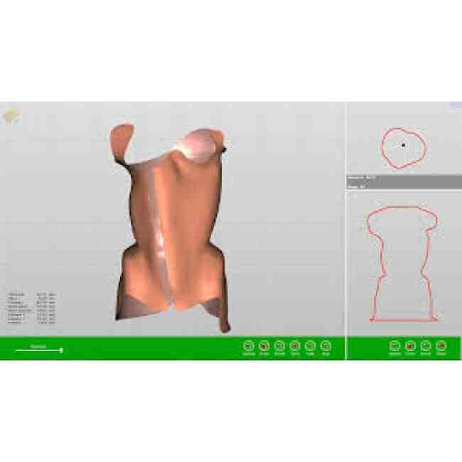 Cad-Cam Kişiye Özel Tasarımlı Skolyoz Korsesi