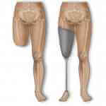 Diz Üstü Protezleri