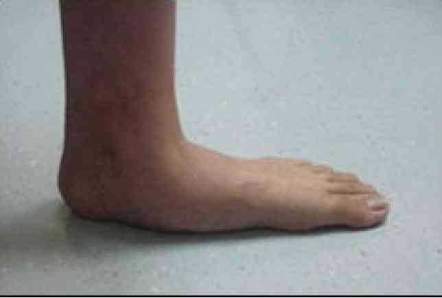 Düz Taban (Pesplanus)