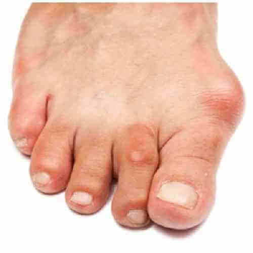 Diğer Ayak Rahatsızlıkları