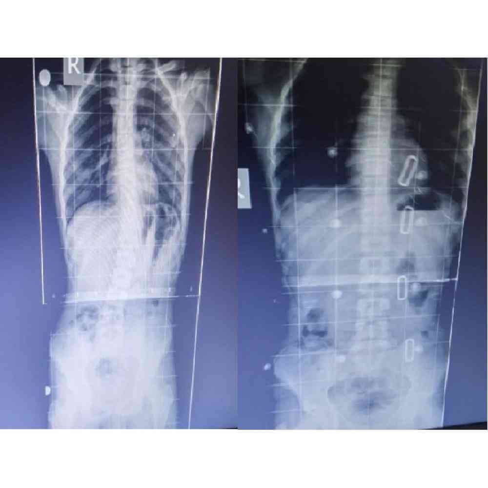 Örnek Korse Uygulamalarımız