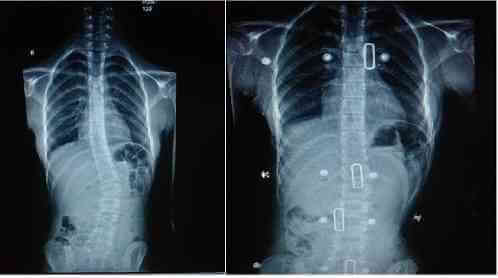 Skolyozun Belirtileri