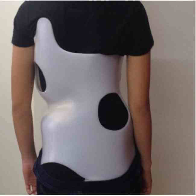 Omurga Deformitesi İçin KORSE Tedavisi