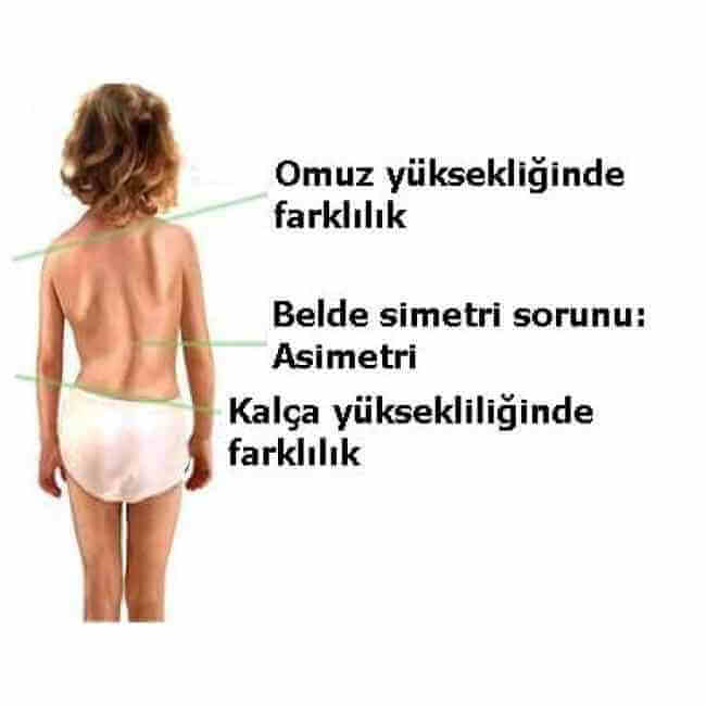 Skolyoz'un Belirtileri