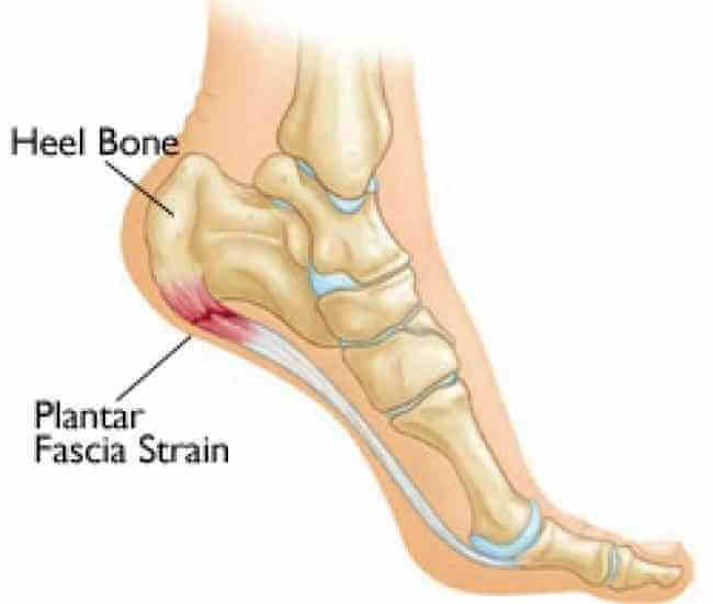 >Topuk dikeni (faciit planter)